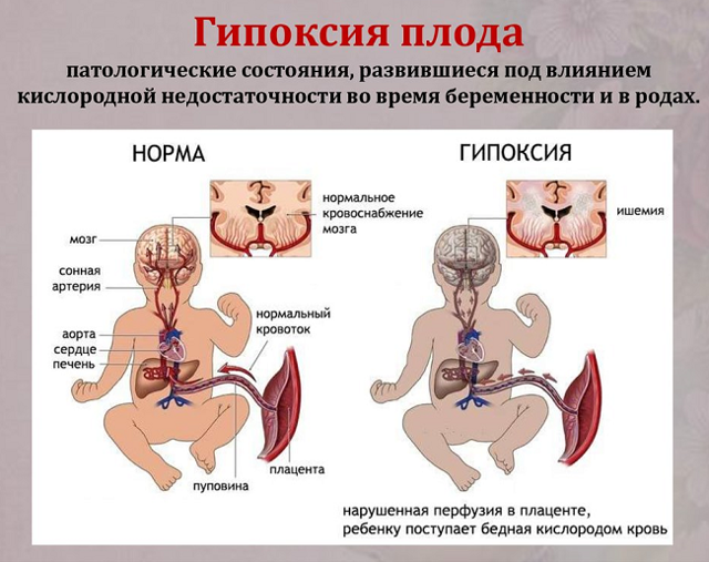 Как лечить ВСД при беременности