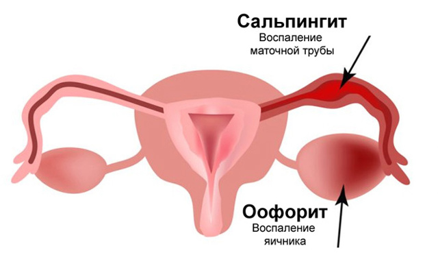 Аднексит - симптомы и лечение острой формы у женщин