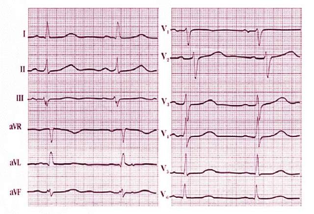 Регулярный и нерегулярный синусовый ритм сердца