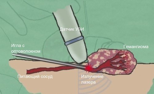 Кавернозная гемангиома - что это такое и может ли пройти сама