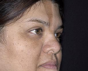 Системная склеродермия - диагностика, лечение, прогноз