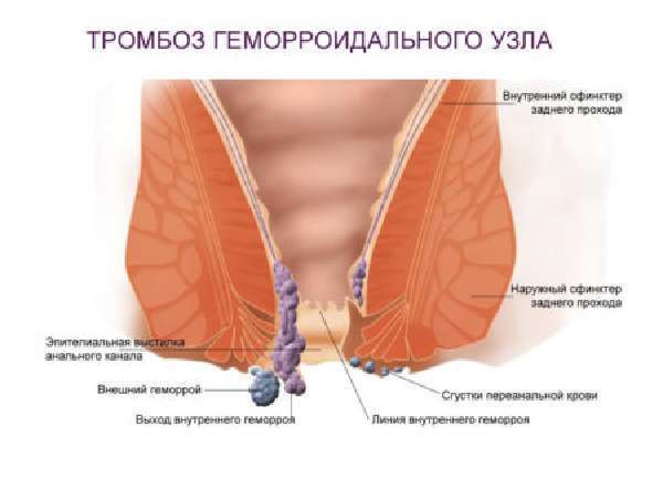 Тромбоз наружного геморроидального узла: причины и лечение