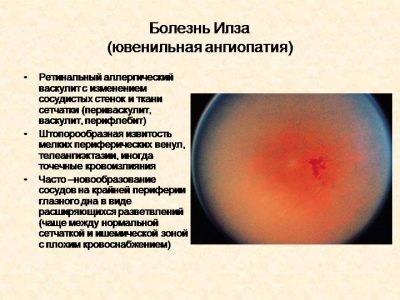 Сосуды глазного дна у ребенка расширены - Лечение гипертонии