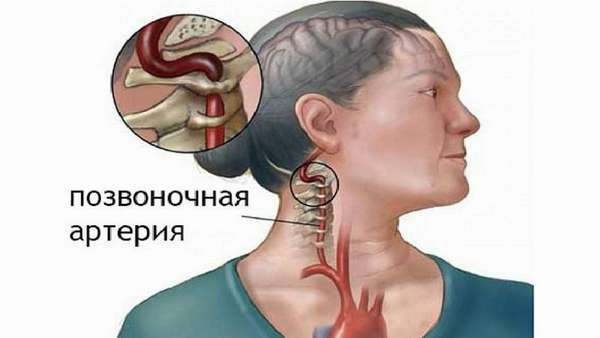 Экстравазальная компрессия позвоночной артерии