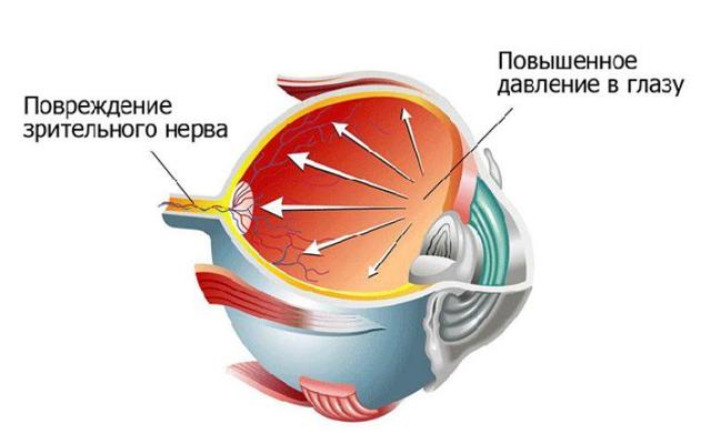 Почему лопаются сосуды в глазах? Причины и лечение