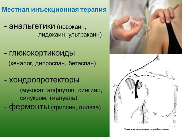 Уколы Дипроспан: инструкция по применению, цена, отзывы и аналоги