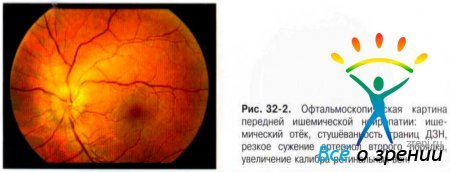 Передняя ишемическая нейропатия