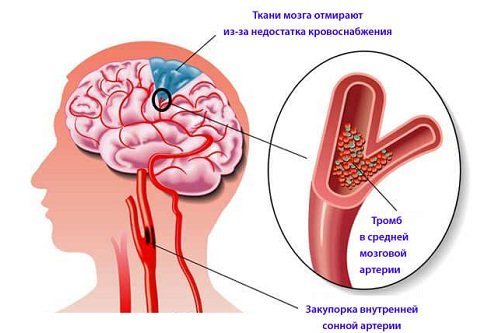 Лечение атеросклероза сосудов головного мозга: препараты, выбор лекарств