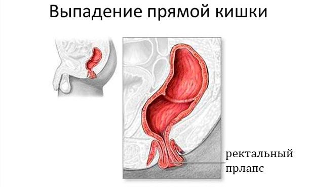 Выпал геморроидальный узел