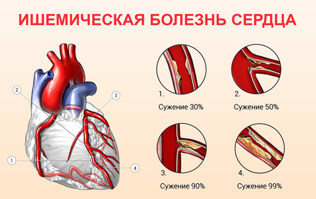 Что принимать при брадикардии