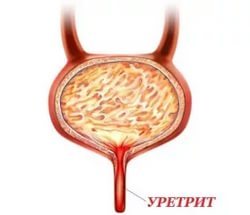 Жжение, боль и рези при мочеиспускании у мужчин и женщин: причины и лечение