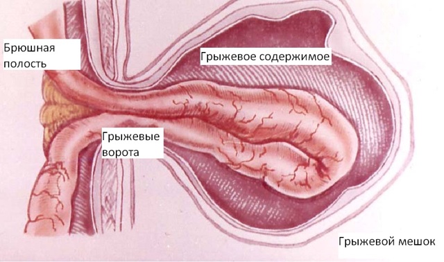 Пупочная грыжа у женщин, у взрослых – симптомы, лечение без операции, операция