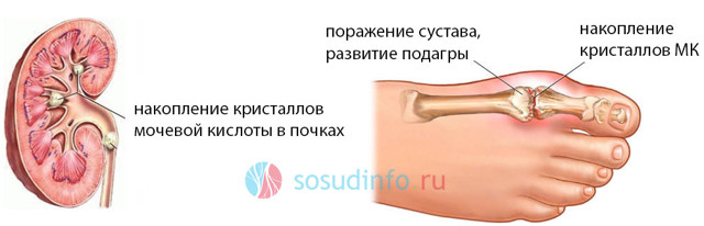 Мочевая кислота составляет уменя 755 что делать. Какая норма мочевой кислоты в крови мужчин, женщин и детей