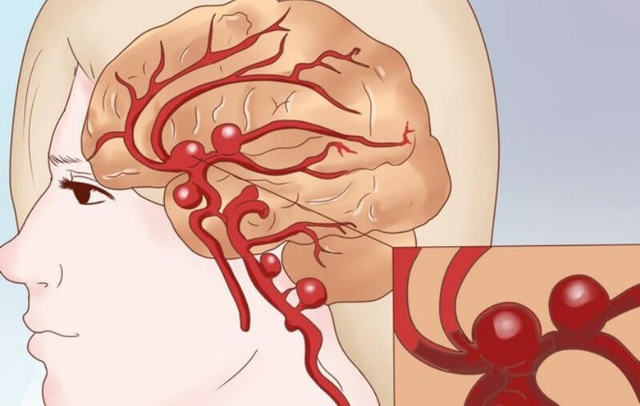 Симтомы, диагностика и лечение закупорки кровеносных сосудов