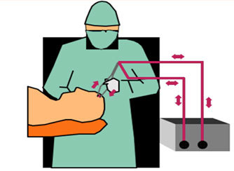 Электрохирургический коагулятор (ЭХВЧ-аппарат): обзор, основные функции и назначение