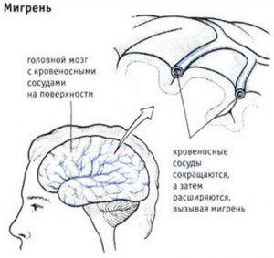 Лечение мигрени: препараты, методы и первая помощь