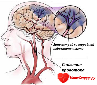 Хроническая ишемия головного мозга 2 ст декомпенсация - Все про гипертонию