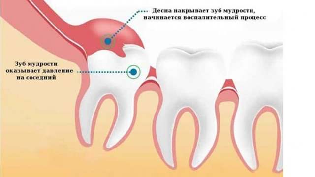 Красные Десна Вокруг Зуба и Болит Что Делать, Как Избавится?