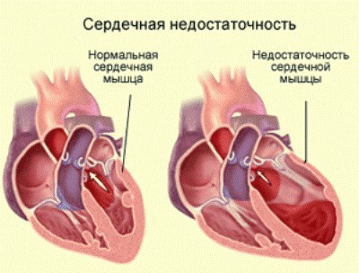 Левожелудочковая недостаточность: симптомы, лечение