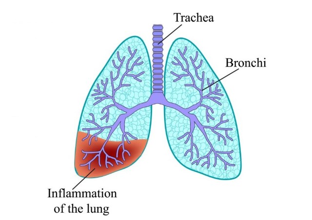 Мокрота с кровью при кашле – кровь в слизи при отхаркивании 2019