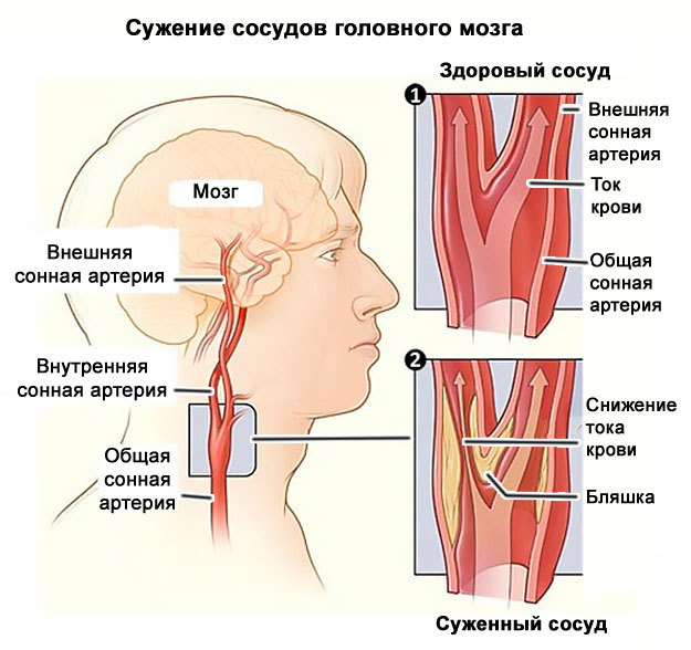 Спазм сосудов головного мозга: симптомы и причины