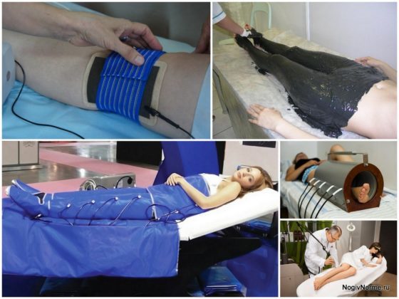 Послеоперационный период при операции на венах ног