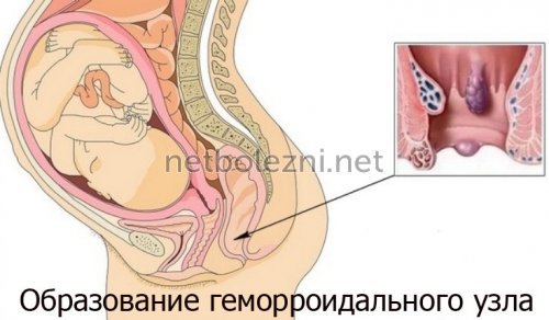Геморрой при беременности - чем и как лечить геморрой беременной?