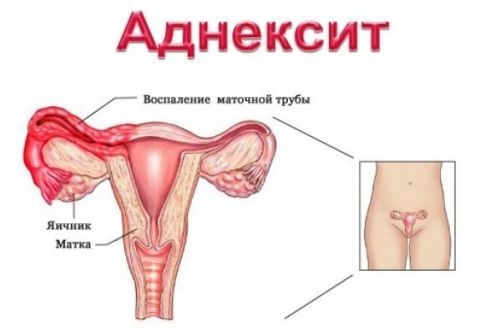 Свечи при аднексите (сальпингоофорите): виды, плюсы и минусы
