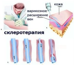Склеротерапия вен нижних конечностей: плюсы и минусы