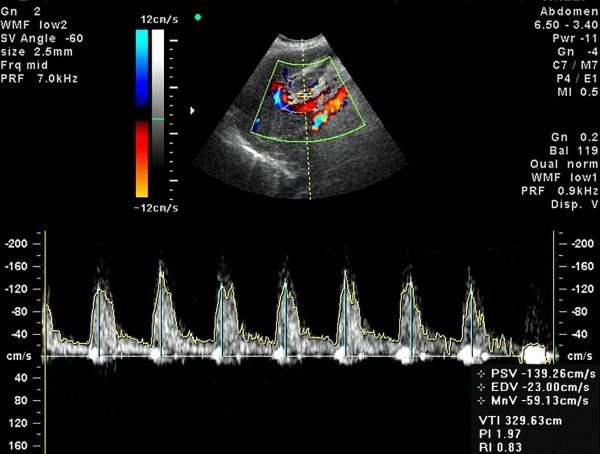 Аортальный порок сердца: симптомы и лечение
