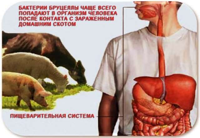 Бруцеллез: что это, симптомы у человека, лечение, диагностика