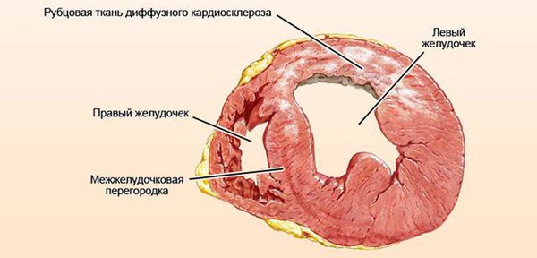 Симптомы и лечение дистрофии миокарда