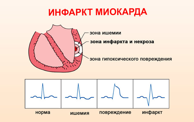 Абдоминальная форма инфаркта миокарда: симптомы