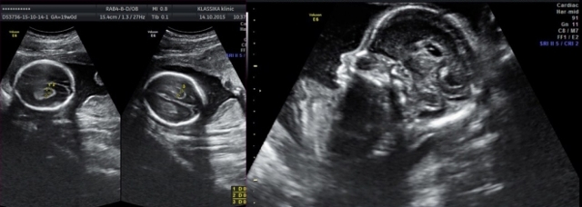 Киста сосудистого сплетения головного мозга: возникновение, диагностика, лечение. Опасна ли киста сосудистого сплетения для новорожденного?