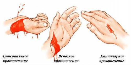 Правила наложения жгута: этапы, особенности, контроль