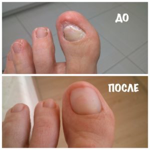 Формидрон от грибка ногтей: отзывы, цена, инструкция