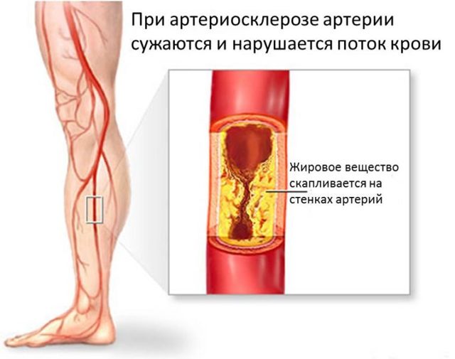 Облитерирующий атеросклероз сосудов нижних конечностей – симптомы и лечение