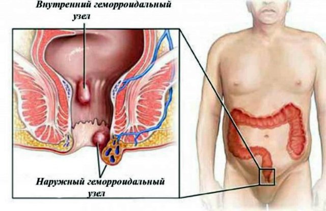 Как геморрой влияет на простату - Простатит