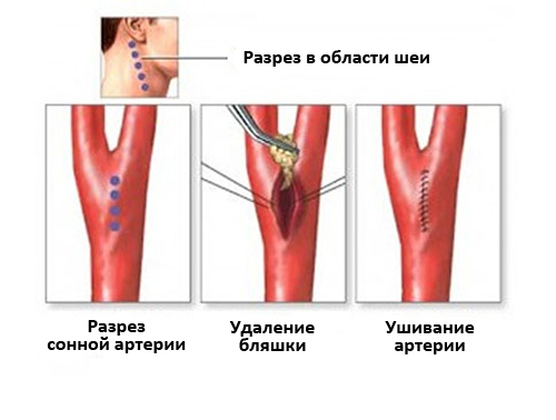Стенозы сонных артерий и современные методы их лечения