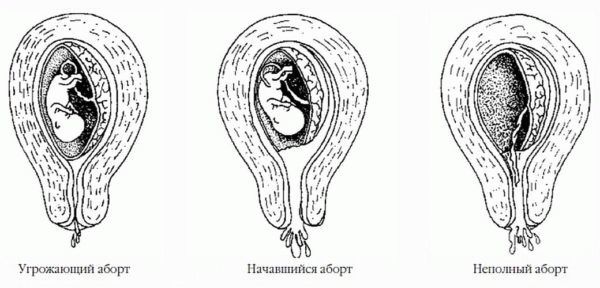 Коричневые выделения при беременности на ранних сроках: светло, темно коричневые в первом триместре на 3-5, 6-12 неделях