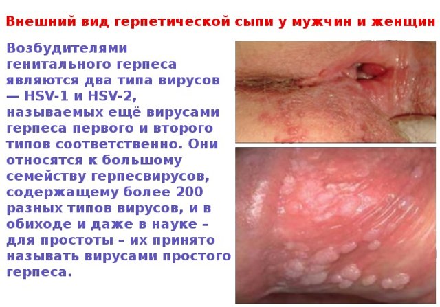 Генитальный герпес - фото проявлений у мужчин и женщин