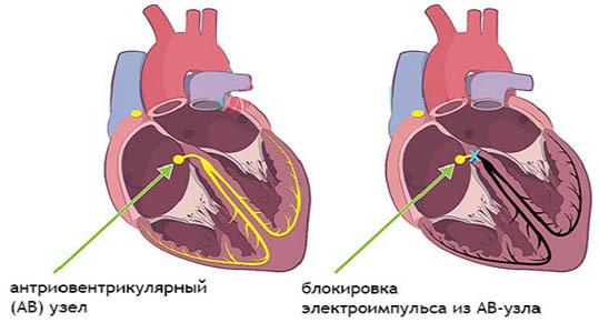 Аритмия: симптомы, диагностика, лечение