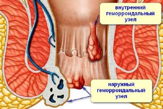 Что нужно делать если геморрой вылез наружу и болит