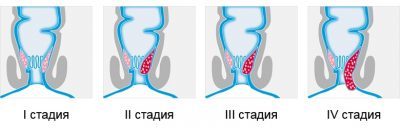 Какой врач лечит геморрой у мужчин