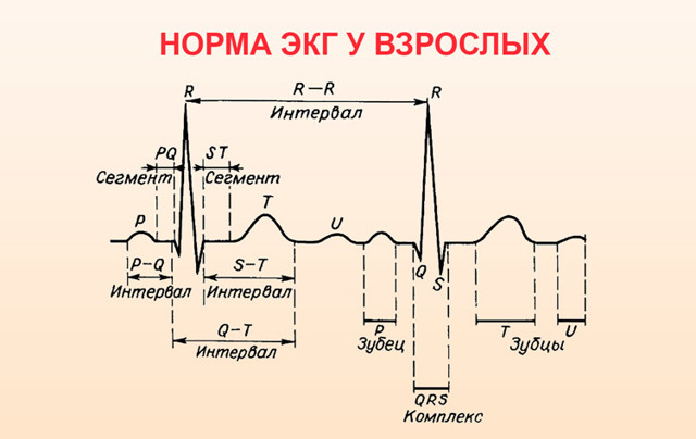Инфаркт миокарда на ЭКГ: признаки, расшифровка