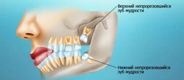 Перикоронарит зуба мудрости - формы, симптомы и лечение