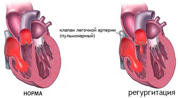 Пролапс митрального клапана с регургитацией 2 степени