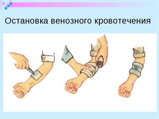 Большая энциклопедия нефти и газа. Признаки артериального кровотечения и венозного.