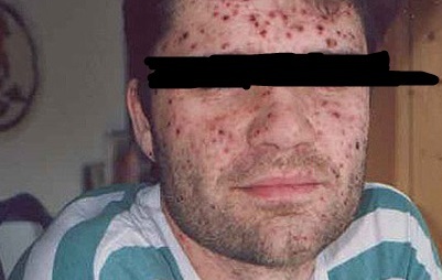Ветрянка у взрослых симптомы и лечение