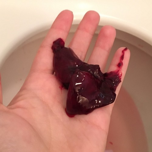 Месячные идут со сгустками крови и кусками — причины